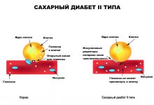 Photo of Молекулярные механизмы развития диабета