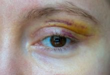 Photo of Последствия неправильного лечения диабета