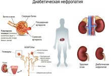 Photo of Классификация диабетической нейропатии