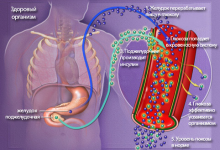 Photo of Механизм развития диабета типа 1