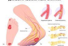Photo of Диабетическая нейропатия: симптомы и лечение