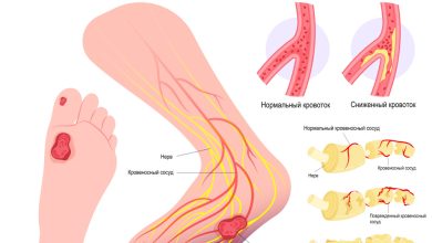 Photo of Диабетическая нейропатия: симптомы и лечение
