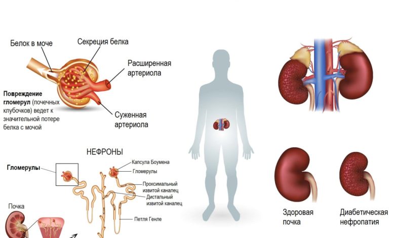 Photo of Диабет и осложнения на почках