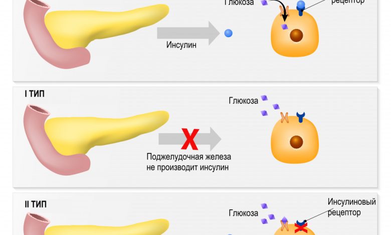 Разновидности диабета: что знать?